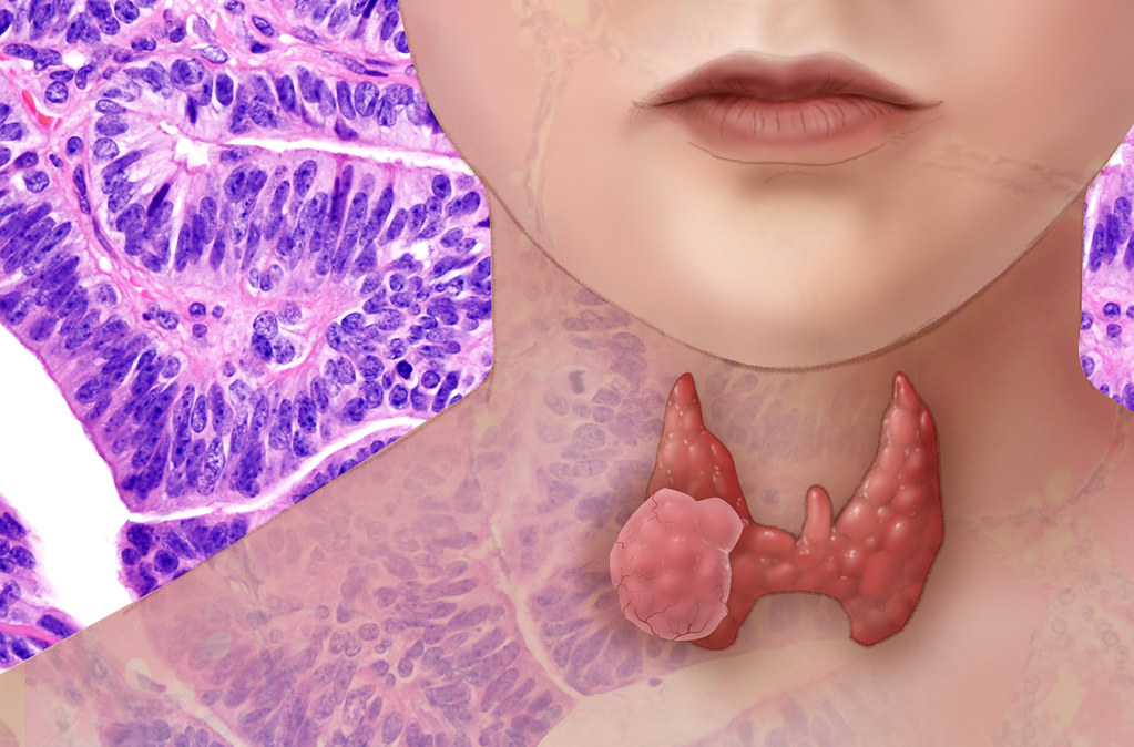 Pruebas de Tiroides en Zonar: Detectando Problemas Hormonales